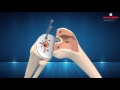 NEW WAVE Surgical Technique 3D Animation