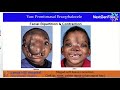 NextGenFace Craniofacial Conference 2021: Craniofacial Surgery - James Bradley, MD, FACS