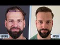 Month by Month #hairtransplant Time Lapse Before After Results #hairtransplantturkey #4500grafts