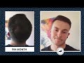 YOUNGER TODAY! Josh's 9 Month Results from Norwood V - 5! | Smile Hair Clinic