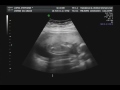 Baby Sophia - Ultrasound 18w5d Part 1