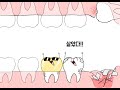 Wisdom teeth Animation
