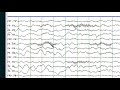 Focal EEG Abnormalities 1