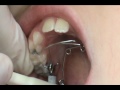 Placement of the Quad Helix Expander
