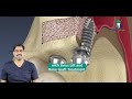 How sinus lift & bone grafting is done Dr.Karthikeyan explains in tamil -எலும்பில்லாத மேல் பல் கட்ட?