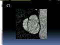 Echocardiographic assessment of bicuspid aortic valve