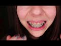 1 YEAR ADULT BRACES UPDATE🦷|Progress, Elastics, Current Routine + More!