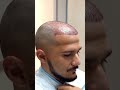 Hair Transplant, a simple procedure that can change your self-esteem | Care4Hair