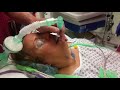 ~Tulip - Bronchoscopy and Endotracheal Intubation through a ~Tulip airway Video