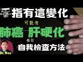 (中英字幕EngSub)99%的人都不知道的肝病皮膚症狀 skin signs of liver disease that most people don't know