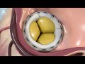 Mitral valve replacement technology - 3D animation