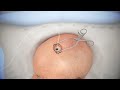 Ventriculostomy Brain Surgery - 3d animation