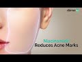 The Derma Co |  Sali-Cinamide Serum for Acne & Acne Marks