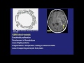 Imaging features of meningiomas - Part 1