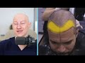 I Went To Turkey For A Hair Transplant | Hair Surgeon Reacts