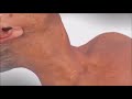 TCAR Procedure Animation (Carotid Artery Disease Treatment)