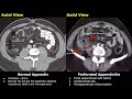 Appendix CT Scan Normal Vs Appendicitis Images | Acute, Gangrenous Types & Perforated Appendix