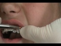 Part 2: How are braces put on? Dr. Powell demonstrates!