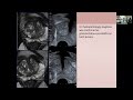 Pitfalls in Prostate MRI