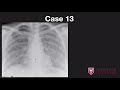 Chest x-ray case review