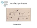 Marfan Syndrome - Diagnosis by Prof Julie De Backer