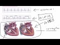 Atrial Fibrillation