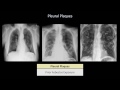 How to Interpret a Chest X-Ray (Lesson 6 - Diaphragm and Pleura)