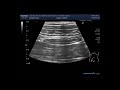 The scanning and localization of Acute Appendicitis.