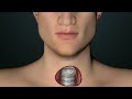 Thyroid Nodule Workup - What Happens Next? Is it Cancer?