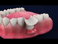 How to Perform Dental Implants by MIS -Tutorial (3D Dental Animation)
