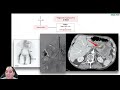 GI Bleed | Clinical Medicine